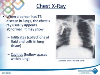 Chest X-Ray
• When a person has TB
disease in lungs, the chest x-
ray usually appears
abnormal. It may show:
– Infiltrates (collections of
fluid and cells in lung
tissue)
– Cavities (hollow spaces
within lung)
26
Abnormal chest x-ray with cavity
 