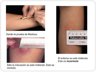 Dando la prueba de Mantoux
Sólo la induración se está midiendo. Esto es
correcto.
El eritema se está midiendo.
Esto es incorrecto
 