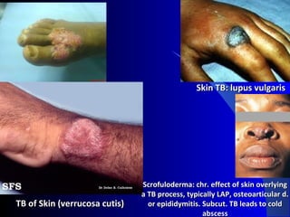 Scrolufoderma Childhood Tuberculosis | PPT