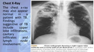 Chest X-Ray
The chest x-ray
may also appear
normal in a
patient with TB.
Findings
suggestive of TB
include upper
lobe infiltrations,
cavitary
infiltrates and
lymph node
involvement.
30-04-2020 32
 