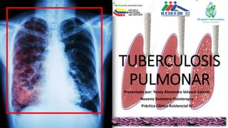 TUBERCULOSIS
PULMONAR
Presentado por: Yesny Alexandra Velasco Salazar
Noveno Semestre Fisioterapia
Práctica Clínico Asistencial IV
 