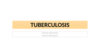 TUBERCULOSIS
MITHUN VENUGOPAL
DEPT.OF PATHOLOGY
 