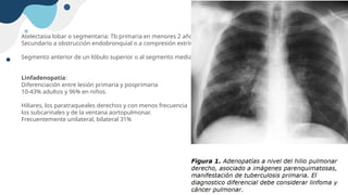 Atelectasia lobar o segmentaria: Tb primaria en menores 2 años, niños mayores 9% y adultos 18%
Secundario a obstrucción endobronquial o a compresión extrínseca por adenopatías.
Segmento anterior de un lóbulo superior o al segmento medial del lóbulo medio
Linfadenopatía:
Diferenciación entre lesión primaria y posprimaria
10-43% adultos y 96% en niños.
Hiliares, los paratraqueales derechos y con menos frecuencia
los subcarinales y de la ventana aortopulmonar.
Frecuentemente unilateral, bilateral 31%
 