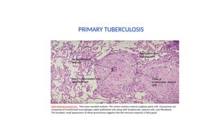 Caseated Mycobacterium tuberculosis diagnosis and treatment.pptx