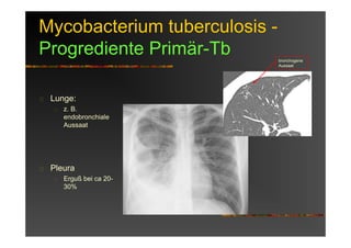 Mycobacterium tuberculosis -
Progrediente Primär-Tb
Lunge:
z. B.
endobronchiale
Aussaat
Pleura
Erguß bei ca 20-
30%
bronchogene
Aussaat
 