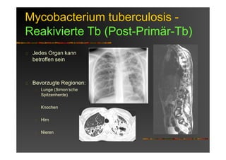 Mycobacterium tuberculosis -
Reakivierte Tb (Post-Primär-Tb)
Jedes Organ kann
betroffen sein
Bevorzugte Regionen:
Lunge (Simon‘sche
Spitzenherde)
Knochen
Hirn
Nieren
 