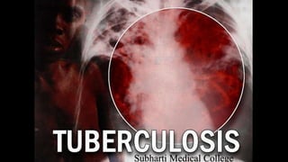 Tuberculosis
Subharti Medical College
Subharti Medical College
 