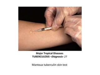 Major Tropical Diseases
TUBERCULOSIS – Management - 28
• Effective TB treatment is difficult *
• Directly Observed Therapy...