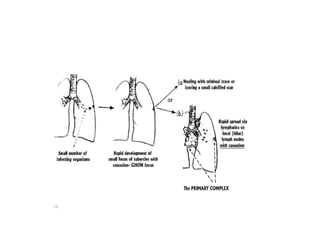 tuberculosis | PPTX