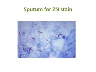Sputum for ZN stain
 