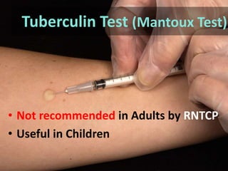 • Not recommended in Adults by RNTCP
• Useful in Children
Tuberculin Test (Mantoux Test)
 