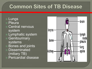  Lungs
 Pleura
 Central nervous
system
 Lymphatic system
 Genitourinary
systems
 Bones and joints
 Disseminated
(miliary TB)
 Pericardial disease
Source: CDC, 2001.
 