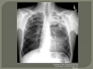 Courtesy of: San Francisco City and
County Dept. of Public Health, TB
Division
 