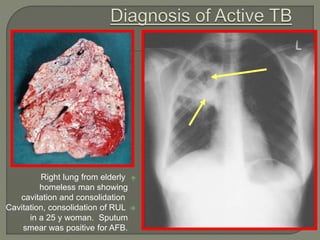 Right lung from elderly
homeless man showing
cavitation and consolidation
Cavitation, consolidation of RUL
in a 25 y woman. Sputum
smear was positive for AFB.
 