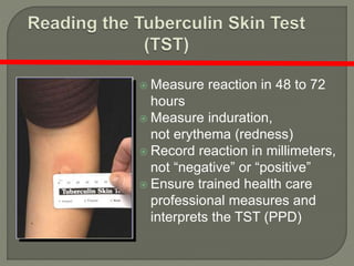  Measure reaction in 48 to 72
hours
 Measure induration,
not erythema (redness)
 Record reaction in millimeters,
not “negative” or “positive”
 Ensure trained health care
professional measures and
interprets the TST (PPD)
 