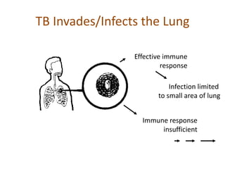 TB Invades/Infects the Lung
Effective immune
response
Infection limited
to small area of lung
Immune response
insufficient
 