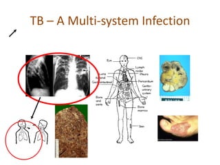 TB – A Multi-system Infection
 