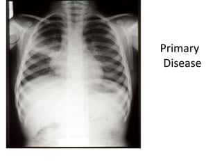 Primary
Disease
 