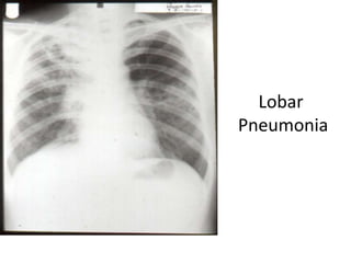 Lobar
Pneumonia
 