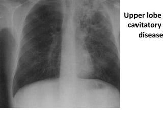 Upper lobe
cavitatory
disease
 