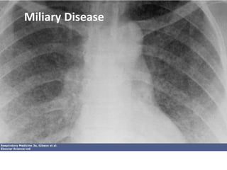 Miliary Disease
 