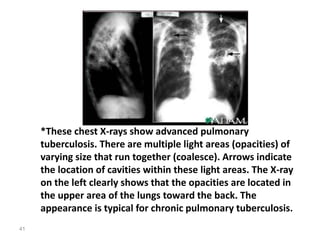 41
*These chest X-rays show advanced pulmonary
tuberculosis. There are multiple light areas (opacities) of
varying size that run together (coalesce). Arrows indicate
the location of cavities within these light areas. The X-ray
on the left clearly shows that the opacities are located in
the upper area of the lungs toward the back. The
appearance is typical for chronic pulmonary tuberculosis.
 