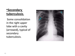 42
*Secondary
tuberculosis.
Some consolidation
in the right upper
lobe with a cavity
(arrowed), typical of
secondary
tuberculosis.
 
