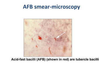 AFB smear-microscopy
Acid-fast bacilli (AFB) (shown in red) are tubercle bacilli
 