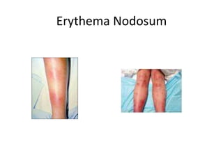 Erythema Nodosum
 