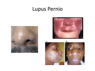 Lupus Pernio
 