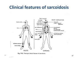 Clinical features of sarcoidosis
87 87
 