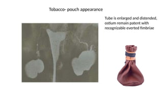 Tobacco- pouch appearance
Tube is enlarged and distended,
ostium remain patent with
recognizable everted fimbriae
 