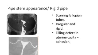 Pipe stem appearance/ Rigid pipe
• Scarring fallopian
tubes.
• Irregular and
rigid.
• Filling defect in
uterine cavity –
adhesion.
 