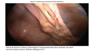 Sharma JB, Sharma E, Sharma S, Dharmendra S. Female genital tuberculosis: Revisited. The Indian
journal of medical research. 2018 Dec;148(Suppl 1):S71.
 