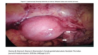 Sharma JB, Sharma E, Sharma S, Dharmendra S. Female genital tuberculosis: Revisited. The Indian
journal of medical research. 2018 Dec;148(Suppl 1):S71.
 