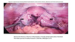 Sharma JB, Sharma E, Sharma S, Dharmendra S. Female genital tuberculosis: Revisited.
The Indian journal of medical research. 2018 Dec;148(Suppl 1):S71.
 