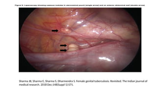 Sharma JB, Sharma E, Sharma S, Dharmendra S. Female genital tuberculosis: Revisited. The Indian journal of
medical research. 2018 Dec;148(Suppl 1):S71.
 