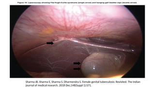 Sharma JB, Sharma E, Sharma S, Dharmendra S. Female genital tuberculosis: Revisited. The Indian
journal of medical research. 2018 Dec;148(Suppl 1):S71.
 