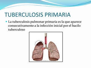 TUBERCULOSIS PRIMARIA
 La tuberculosis pulmonar primaria es la que aparece
consecutivamente a la infección inicial por el bacilo
tuberculoso
 