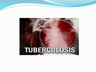 TBC - Tuberculosis general