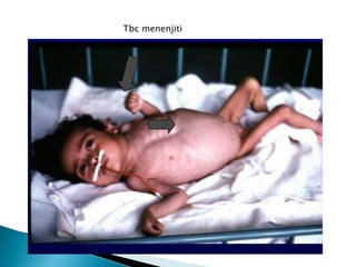 Tbc menenjiti
 