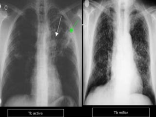 Tb activa   Tb miliar
 
