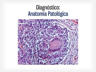 Diagnóstico:
Anatomía Patológica