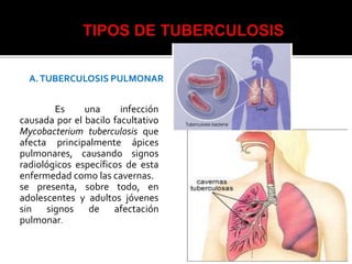 A.TUBERCULOSIS PULMONAR
Es una infección
causada por el bacilo facultativo
Mycobacterium tuberculosis que
afecta principalmente ápices
pulmonares, causando signos
radiológicos específicos de esta
enfermedad como las cavernas.
se presenta, sobre todo, en
adolescentes y adultos jóvenes
sin signos de afectación
pulmonar.
 