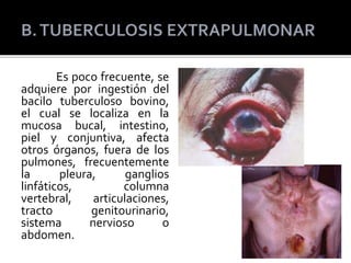 Es poco frecuente, se
adquiere por ingestión del
bacilo tuberculoso bovino,
el cual se localiza en la
mucosa bucal, intestino,
piel y conjuntiva, afecta
otros órganos, fuera de los
pulmones, frecuentemente
la pleura, ganglios
linfáticos, columna
vertebral, articulaciones,
tracto genitourinario,
sistema nervioso o
abdomen.
 