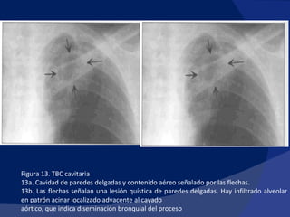 Figura 13. TBC cavitaria 13a. Cavidad de paredes delgadas y contenido aéreo señalado por las flechas. 13b. Las flechas señalan una lesión quística de paredes delgadas. Hay infiltrado alveolar en patrón acinar localizado adyacente al cayado aórtico, que indica diseminación bronquial del proceso 