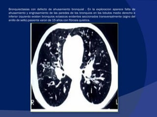 Bronquiectasias con defecto de ahusamiento bronquial . En la exploracion aparece falta de ahusamiento y engrosamiento de las paredes de los bronquios en los lobulos medio derecho e inferior izquierdo existen bronquios ectasicos evidentes seccionados transversalmente (signo del anillo de sello).pasiente varon de 15 años con fibrosis quistica. 