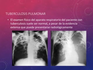 TUBERCULOSIS PULMONAR
• El examen físico del aparato respiratorio del paciente con
tuberculosis suele ser normal, a pesar de la evidencia
extensa que puede presentarse radiológicamente
 