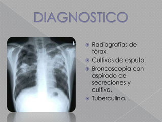    Radiografías de
    tórax.
   Cultivos de esputo.
   Broncoscopia con
    aspirado de
    secreciones y
    cultivo.
   Tuberculina.
 