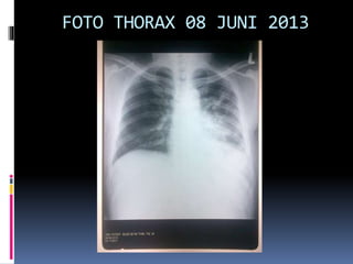 FOTO THORAX 08 JUNI 2013
 